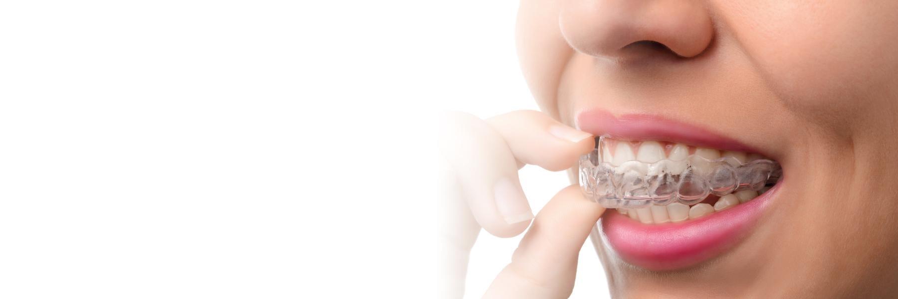 Invisalign and Traditional Braces | Dentist
